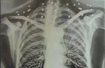 这条摘不下的“项链”成了他的光荣勋章